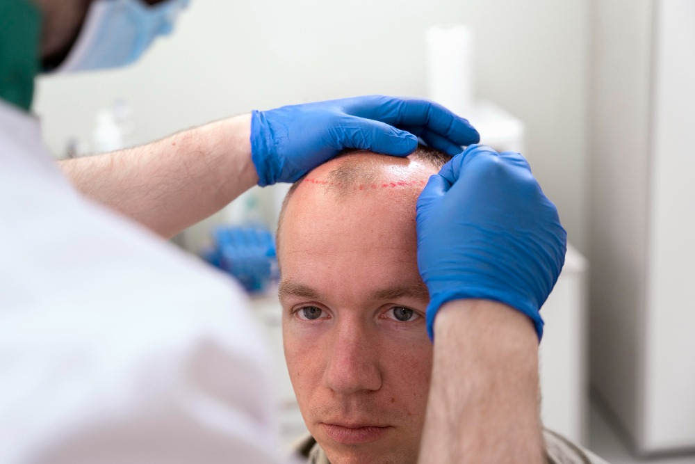 Hair Restoration in Istanbul: A Comprehensive Guide to Hair Transplant in Turkey